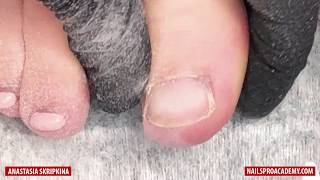 How to remove gel polish from toes [upl. by Adnerad]