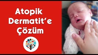 EGZAMADAN KORTİZONSUZ KURTULDUK  Atopik Dermatikten kurtulma yöntemleri [upl. by Levenson388]