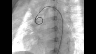 COARTACION AORTA 1 de 3 [upl. by Robertson381]