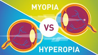 Difference between Myopia Near Sightedness amp Hyperopia FarSightedness [upl. by Enelcaj97]