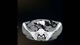 Tuberculosis involving terminal ileum ileocecal junction caecum and ascending colon [upl. by Nalyad371]