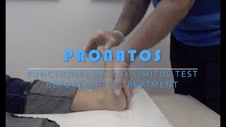 FUNCTIONAL HALLUX LIMITUS TEST BEFORE AND AFTER TREATMENT [upl. by Ioab]