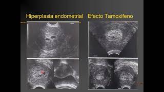 28 y 29 HIPERPLASIA DE ENDOMETRIOADENOCARCINOMADR SANCHEZ [upl. by Lopez]