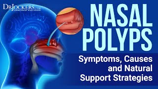 Top 12 Natural Remedies for Nasal Polyps [upl. by Solly]