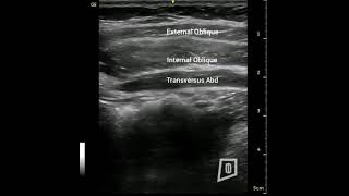 Rectus Sheath Block [upl. by Eilloh]