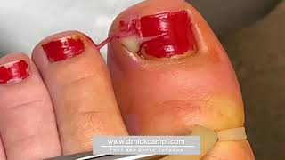 Draining pus from an ingrown toenail [upl. by Iggam107]