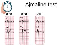 Ajmaline test amp Brugada syndrome [upl. by Eecats297]