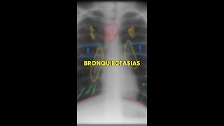 Bronquiectasias no RX [upl. by Jon]