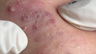 Acne Treatment Huong Da Nang 595  2024 [upl. by Harbour]