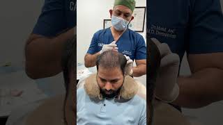 1st PRP Session After Hair Transplant [upl. by Rici]