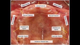 Anatomic Landmarks Maxillary Arch [upl. by Lirbij412]