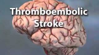 Types of strokeFLV [upl. by Sara]