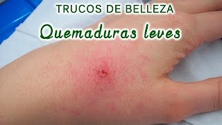 Quemaduras leves de 1 grado remedios naturales para tratarlas [upl. by Onafets]