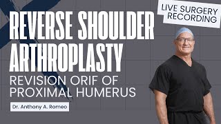 Reverse Shoulder Arthroplasty  Revision of ORIF of Left Proximal Humerus  Anthony A Romeo MD [upl. by Delora]