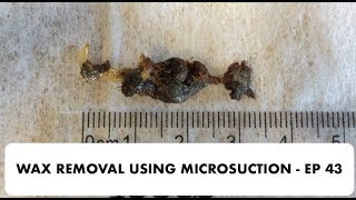 EAR WAX REMOVAL USING MICROSUCTION  EP 43 [upl. by Louie]