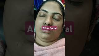 Anti pigmentation facial [upl. by Nnaerb219]