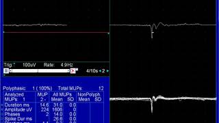 Positive Sharp Waves  Spontaneous Activity  ELECTROMYOGRAPHY  University of Lahore [upl. by Graff]