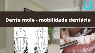 Dentes com Mobilidade dralexguedes [upl. by Avan]