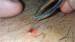 Ingrown Hair removal  Satisfaction  2 [upl. by Auqinat]