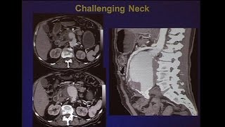 Threeway Debate Treatment of Short Necks Juxtarenal and Pararenal Aneurysms [upl. by Bryan755]