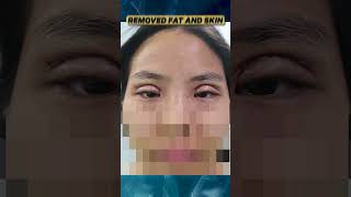 Lid Crease Creation Or Asian Blepharoplasty [upl. by Ocirederf419]