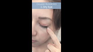 Ocular Rosacea amp Dry Eye [upl. by Intirb]