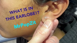 Chronic inflammatory earlobe nugget excised You can see scar ingrown hair and cyst formation [upl. by Enohpesrep769]