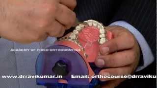 Orthodontic Mini Screw Implant TAD Course [upl. by Losyram]