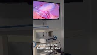 Laproscopic Surgery in Etawah [upl. by Skurnik]