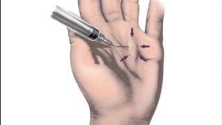 NonSurgical Treatment of Dupuytrens Contracture Brian Fingado MD Orthopedic Hand Specialist [upl. by Stoeber]