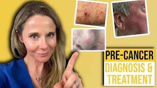 Actinic keratosis treatment guide from a Dermatologist [upl. by Nawoj]