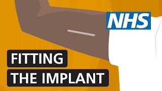 Fitting the contraceptive implant  NHS [upl. by Llebasi]