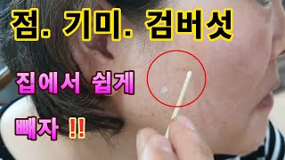 💥💖점 검버섯 기미 제거 집에서 간단하고 쉽게 Mole Black mushrooms Flags Simple and easy to remove at home [upl. by Aenotna59]