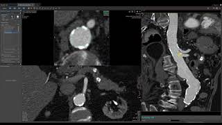 Vitrea Demonstrations  Fenestrated Graft [upl. by Ahtnams]