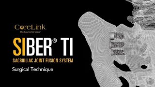 CoreLink Siber Ti Sacroiliac Joint Fusion System Procedure [upl. by Croft]