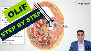 OLIF Oblique Lateral Interbody Fusion  Procedure details recovery expectations and more [upl. by Stavros]