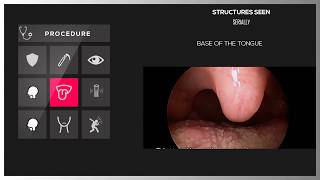 DIRECT LARYNGOSCOPY [upl. by Irrehc]