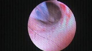 Loop biopsy for suspected endometrial cancer Hysteroscopy [upl. by Suivatra373]