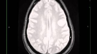 Granulomatous Inflammation Possible IgG4 Disease [upl. by Meehyrb]