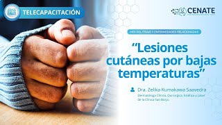 Lesiones cutáneas por bajas temperaturas [upl. by Pampuch]