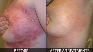 How to treat psoriasis effectively  By Franziska Ringpfeil Board Certified Dermatologist [upl. by Islehc]