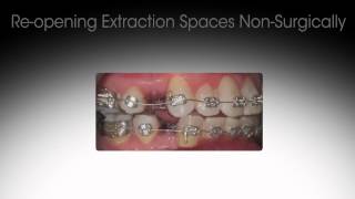 Reversing Previous Orthodontic Treatment [upl. by Enaj]