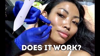 TRYING VIRAL MOLE WARTS SPOT REMOVAL PEN DOES IT WORK [upl. by Marl393]