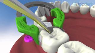 Class II composite restoration using V3 Sectional Matrix System  Triodent [upl. by Azenav727]