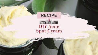 DIY Acne Spot Cream  Home Remedy for Acne with only 4 Natural Ingredients [upl. by Cobby372]