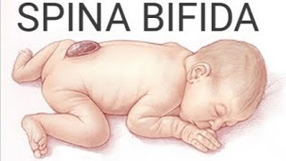 Spina Bifida  TypesCauses Clinical FeaturesDiagnosisPreventionTreatment amp Nursing Management [upl. by Adnil593]