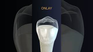 Onlay dental crown [upl. by Ddot688]