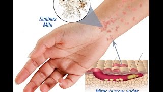 Scabies Causes Symptoms and Treatment [upl. by Hallee]