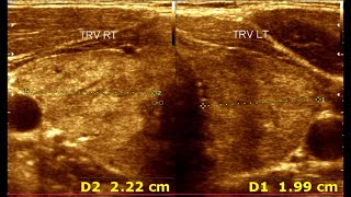 Understanding Ultrasonographic Features of Chronic Thyroiditis [upl. by Lhary532]