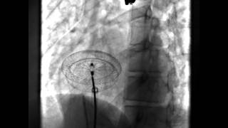 Unstable ASD occluder device position [upl. by Eelano]